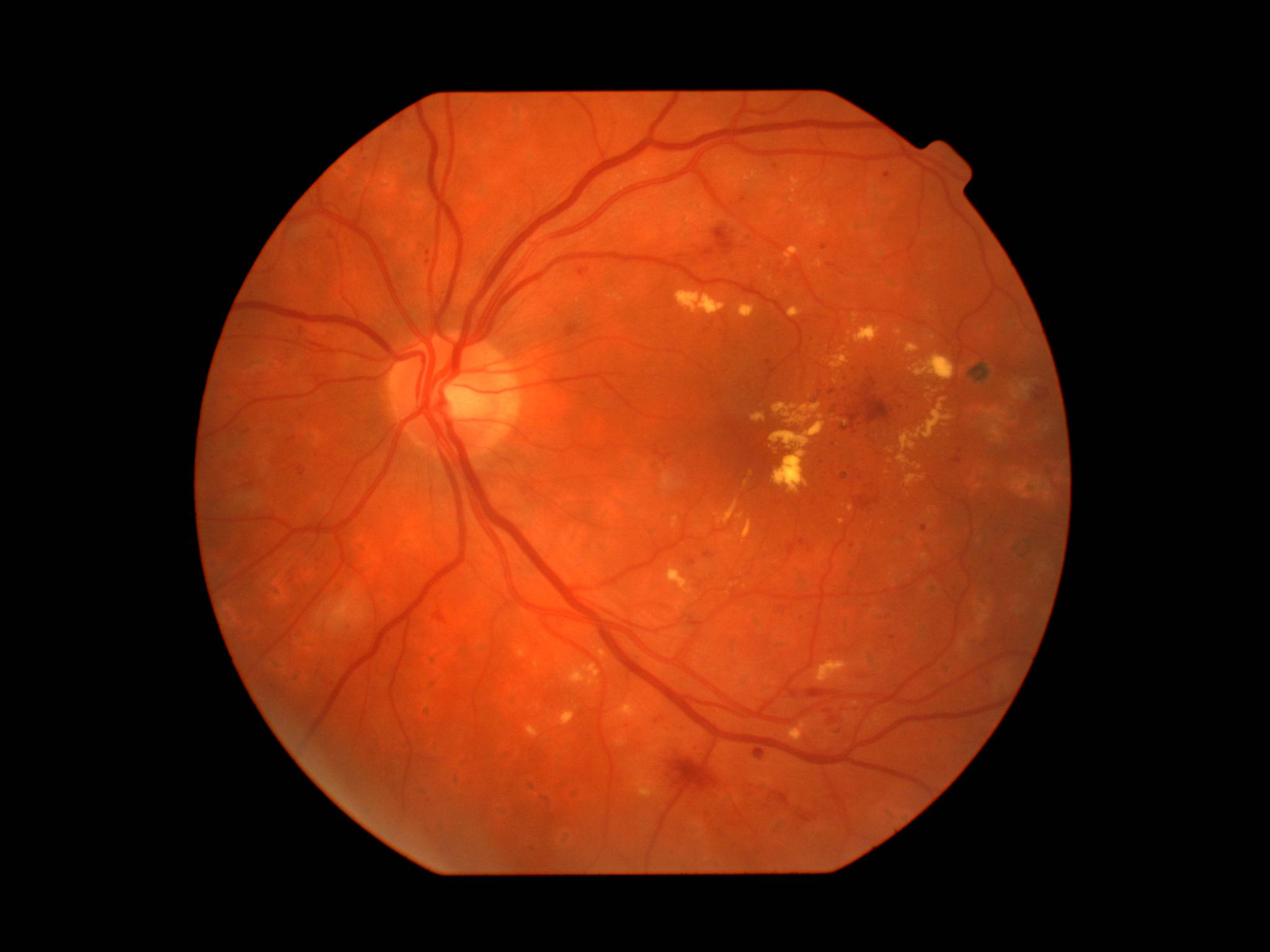 Retinal Disease Classifier — FLAIR vision-language model for diabetic retinopathy and glaucoma detection